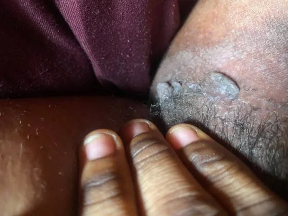 Infection Removal Tea
