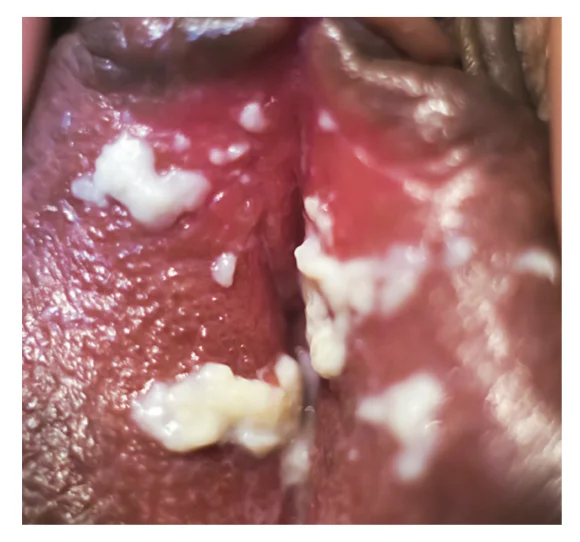 Infection Removal Tea