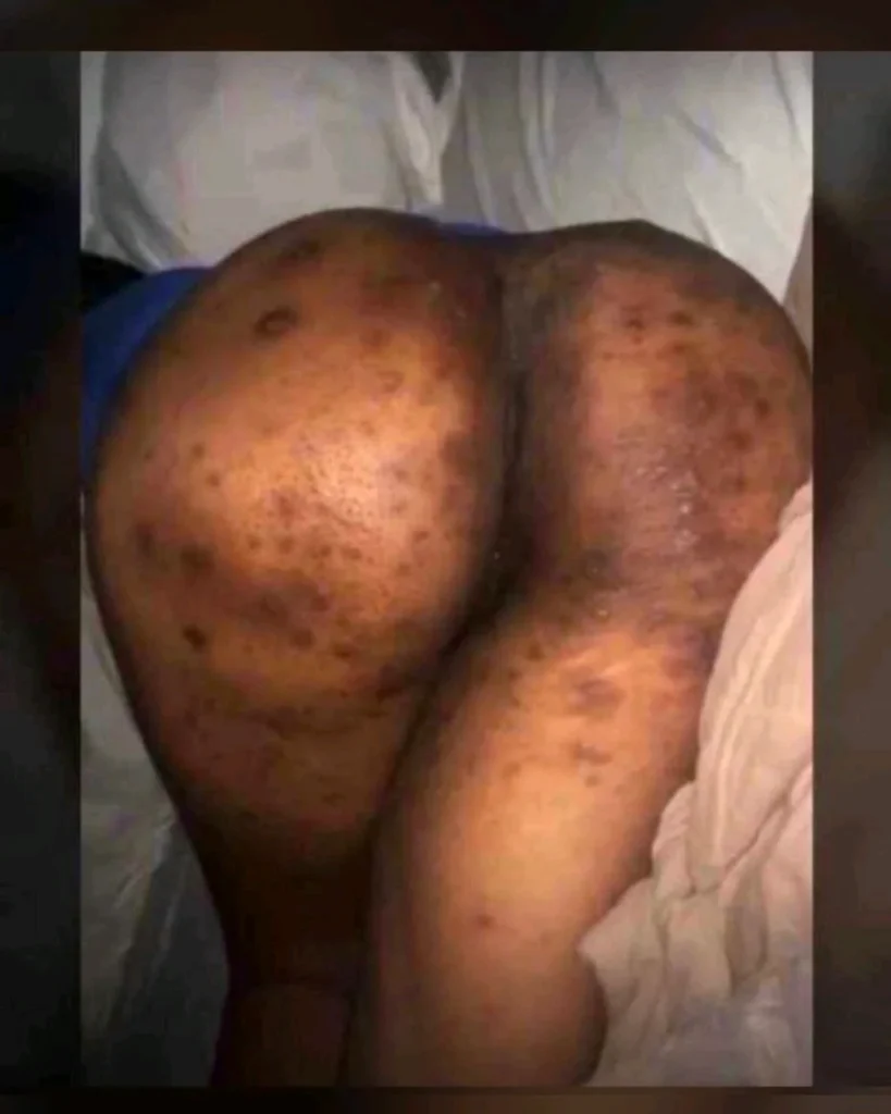 Infection Removal Tea